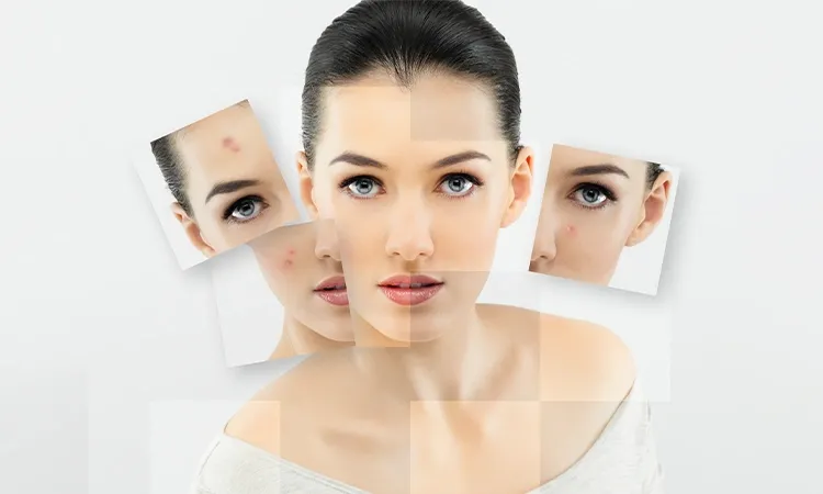 Different Types of Acne Scars and Homeopathy Treatment for Acne
