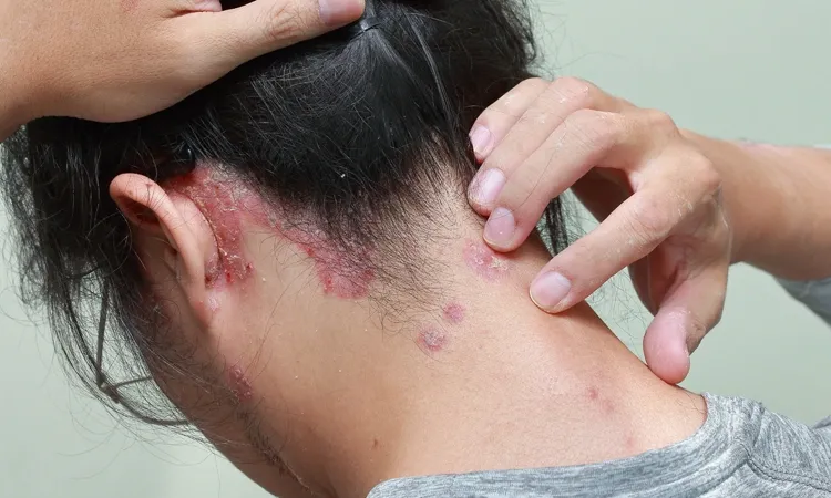 All about Scalp Psoriasis