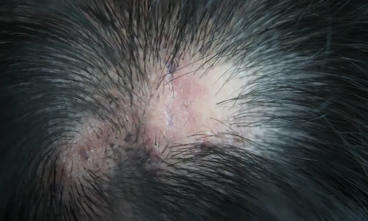 Answering Questions on Scalp Lichen Planus