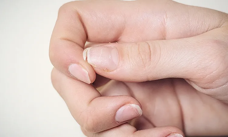 Hypothyroidism and Brittle Nails