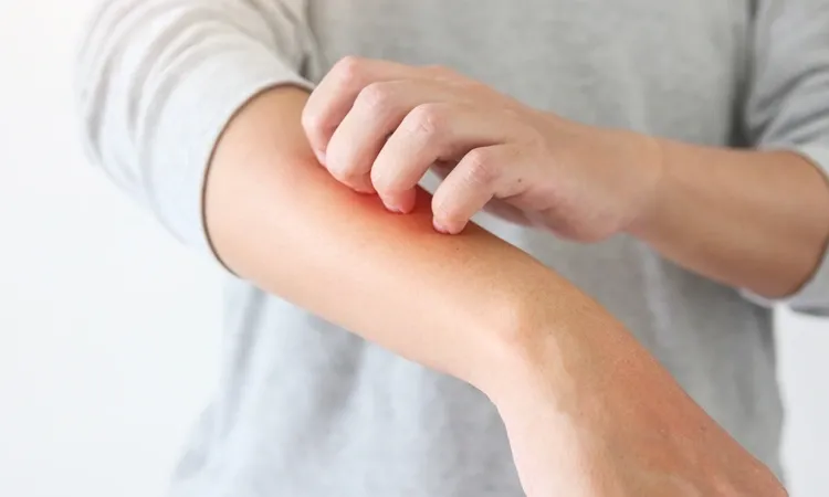 5 things that may make eczema worse