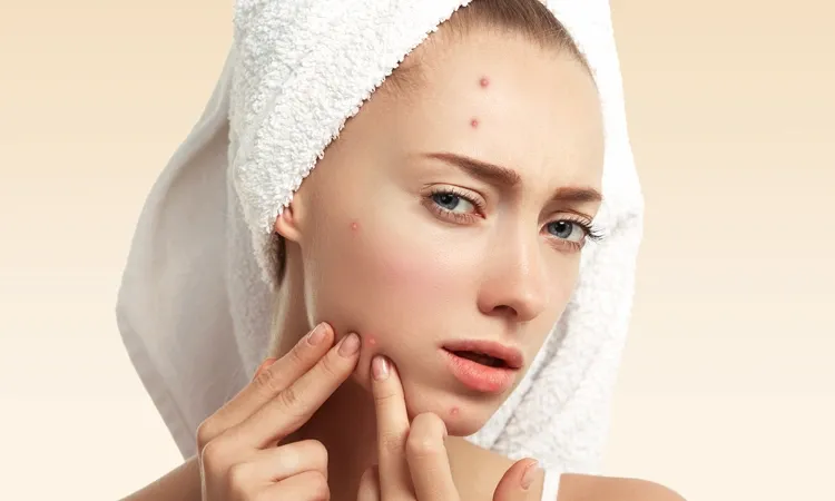 HOMEOPATHY & ACNE