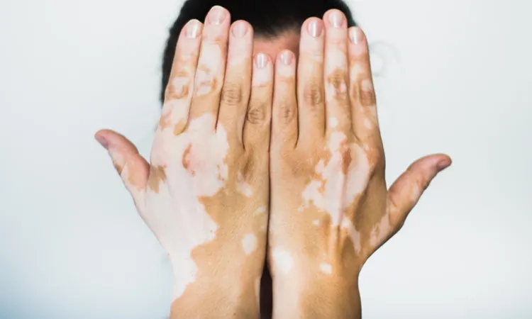Living life with Vitiligo Skin Disease