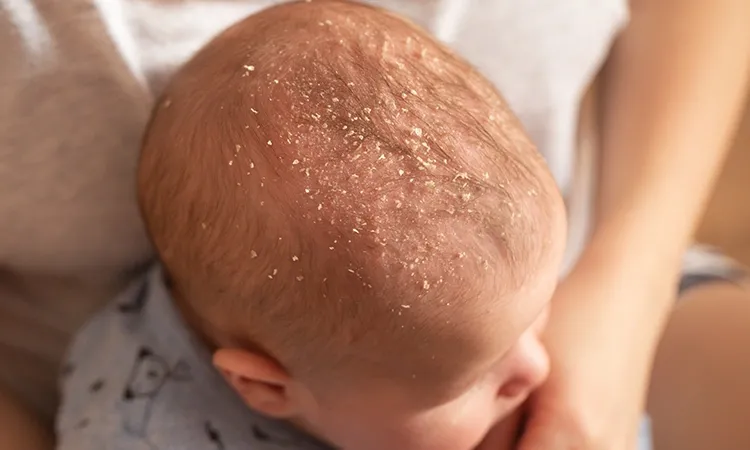 My baby’s head is full of yellowish oily scales…