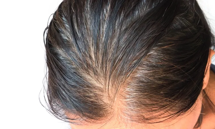 My Speedy Thinning Hair… Only Homoeopathy Took Care…