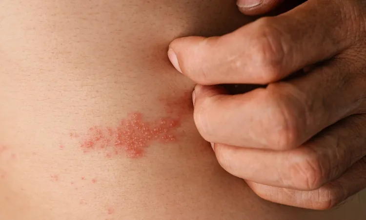Role of Homoeopathy in Treating Lichen Planus