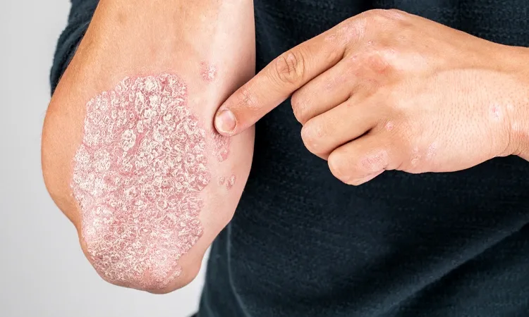 Treat psoriasis with homeopathy