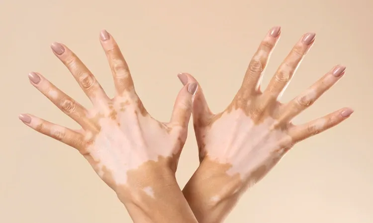 The 'White Lies': Debunking Vitiligo Myths & Facts