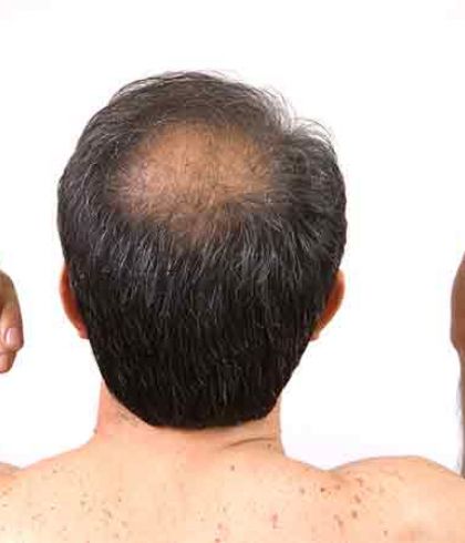 10 Common Reasons for Hair Loss in Men