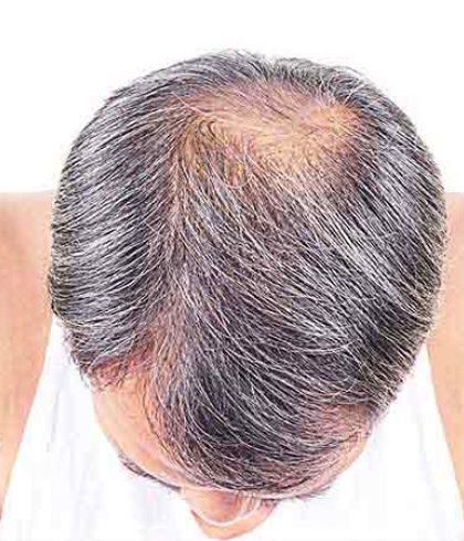 Hair loss  Symptoms and causes  Mayo Clinic