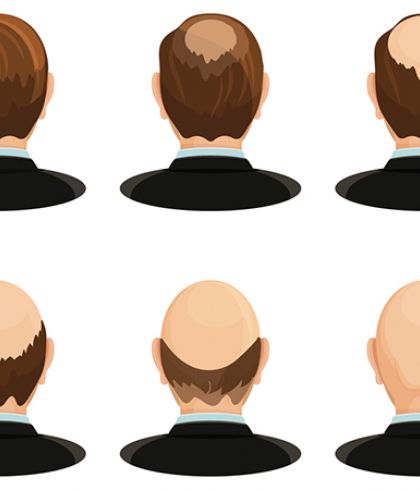 Can hereditary hair loss be cured? | Dr Batra's™ Can hereditary hair loss be cured? | Dr Batra's™