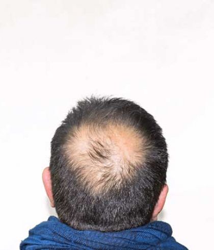 Losing hair in patches could be an autoimmune disorder. Check with your  doctor now. | Dr Batra's™