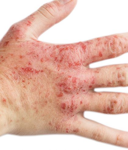 What Are The 7 Different Types Of Eczema Dr Batra S