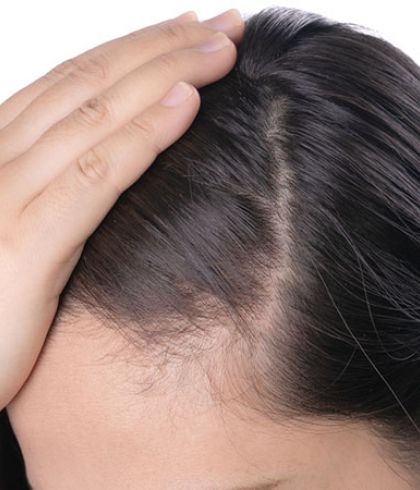 Thinning hair? It might be female pattern baldness. | Dr Batra's™ Thinning hair? It might be female pattern baldness. | Dr Batra's™