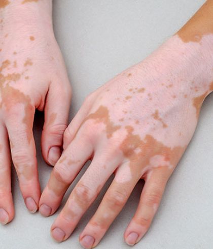 Vitiligo