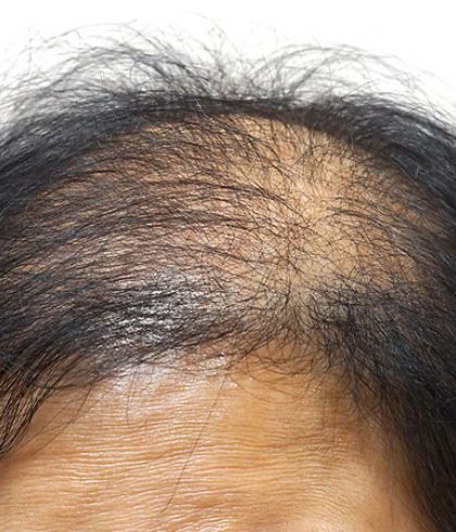 Is your hair loss just due to stress or there is some underlying disease  causing it? | Dr Batra's™