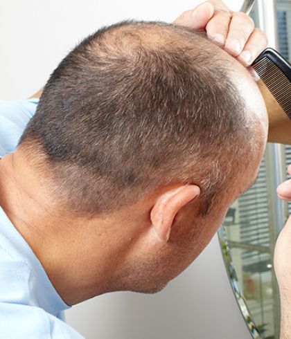 Difference between normal hair loss and advancing male pattern baldness |  Dr Batra's™