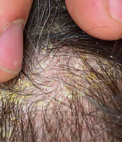 Know how homeopathy treats scalp psoriasis | Dr Batra's™