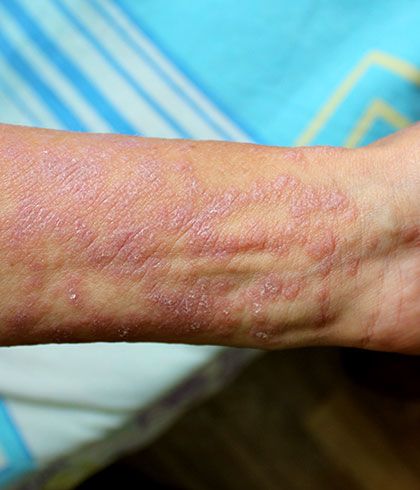 Freedom from leisons of Lichen Planus with Homeopathy