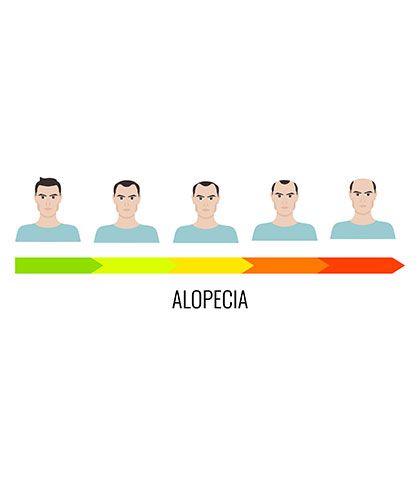 Losing hair due to Alopecia- Treat it with Homeopathy