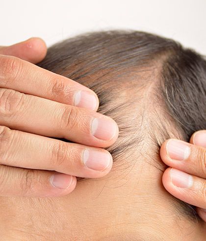 How can Homoeopathy help me with my thinning hair?