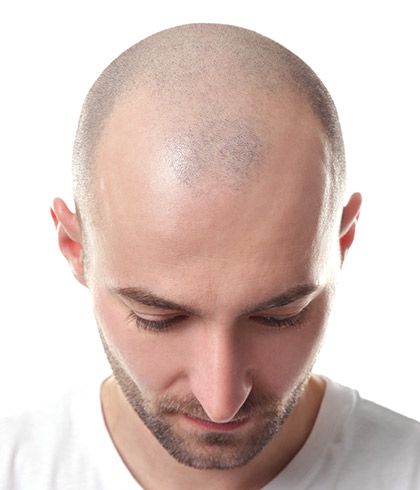 Homeopathy Effectively Treats Alopecia Totalis