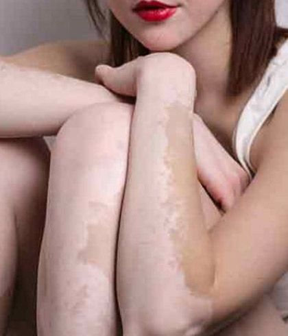 Homeopathy cure for White Patches