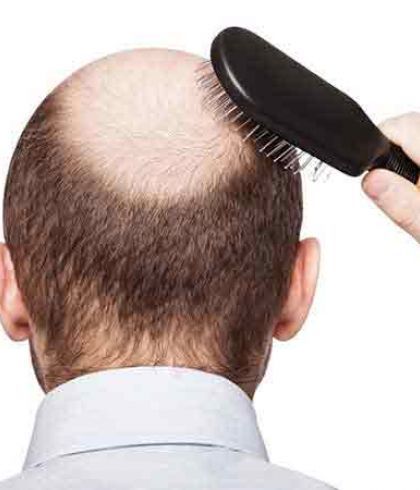 How to cure Male Pattern Baldness| Consult Dr Batra's™
