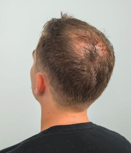 Causes of male pattern baldness - hair loss advice in London