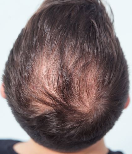 How to Fight Male Pattern Baldness with Homeopathy?