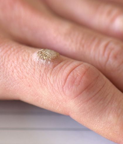 How to treat warts effectively with homeopathy?