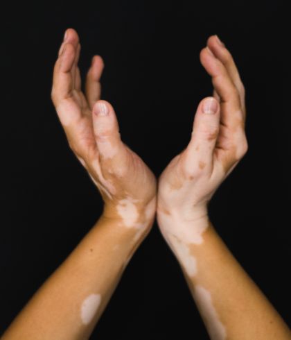 Homeopathy Most Effective Treatment For Vitiligo Dr Batraтащsтдв Homeopathy Most Effective Treatment For Vitiligo Dr Batraтащsтдв