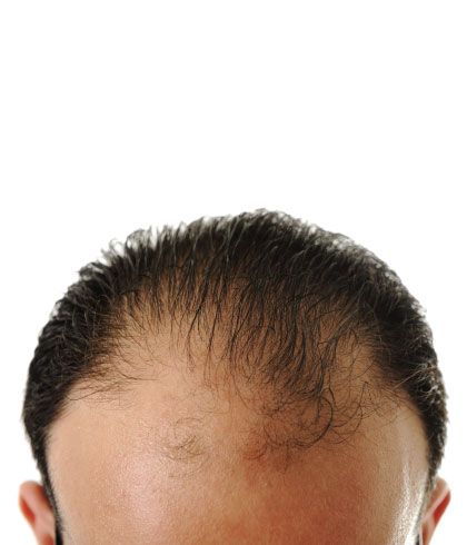 Hairstyles For Thinning Hair  Causes And Treatments To Stop Hair Loss