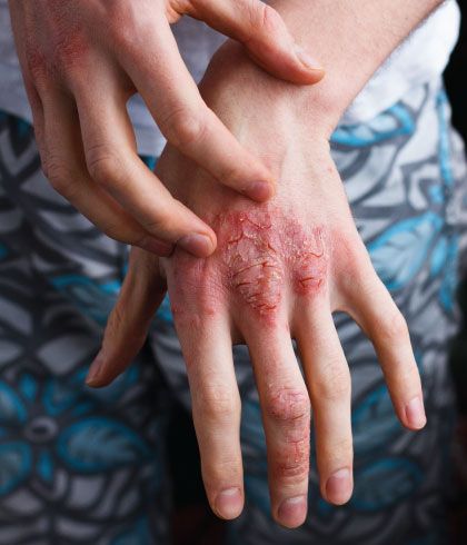 Eczema triggers and how to avoid them?