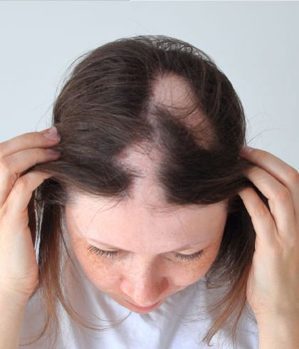 Causes of Alopecia | Dr Batra's™
