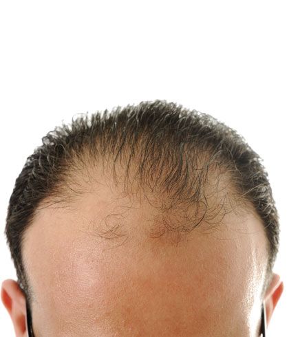 How to Beat Male Pattern Baldness? | Dr Batra's™
