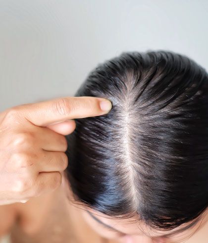 Causes of hair loss in women | Dr Batra's™ Causes of hair loss in women | Dr Batra's™