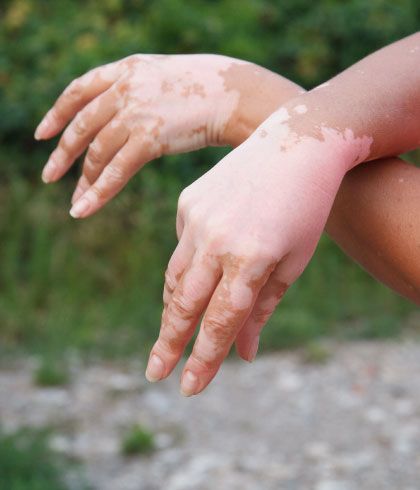 Is Vitiligo Hereditary?