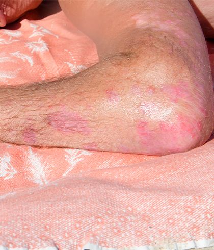 Psoriasis gets worse in summer?