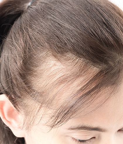 Going bald too young? | Ohio State Medical Center