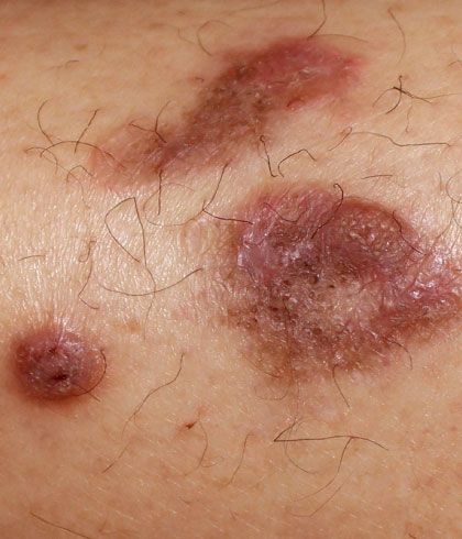 Can lichen planus cause skin rash?