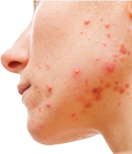 What causes monsoon acne and how to deal with it?