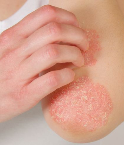 How to prevent psoriasis from recurring?