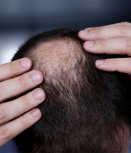 The Bald Truth Of Men Losing Hair In Their 20s - Dr. Batra's®