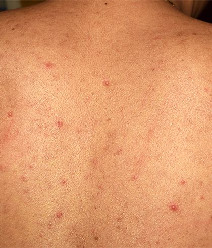 how do u get rid of pimples on your back