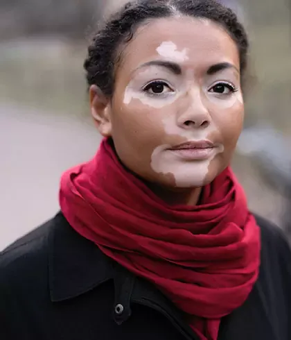 10 reasons Homoeopathy is good for Vitiligo
