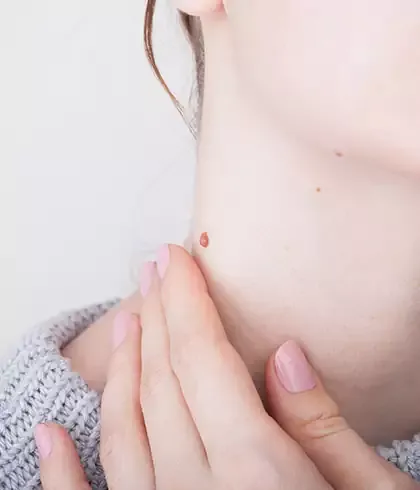 Homeopathic Treatment for Warts