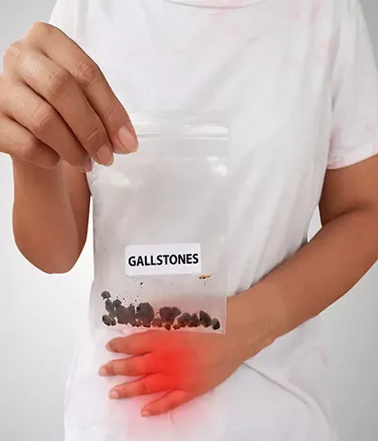 Roll out gallstones using homeopathy