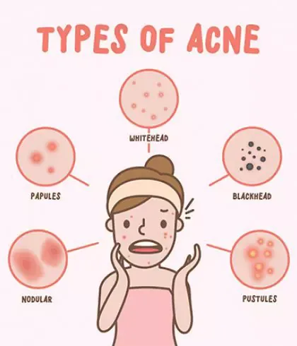 Different Types of Acne