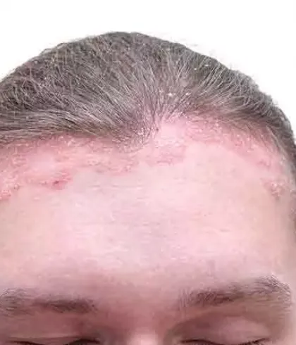 Scalp Psoriasis  Itchy Scalp  Dry Scalp  Scalp Crusting